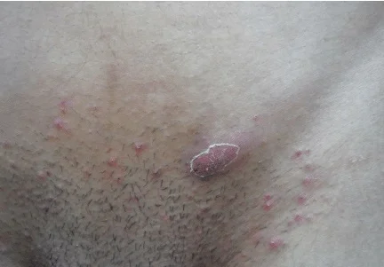 فولیکول مو در ناحیه تناسلی
