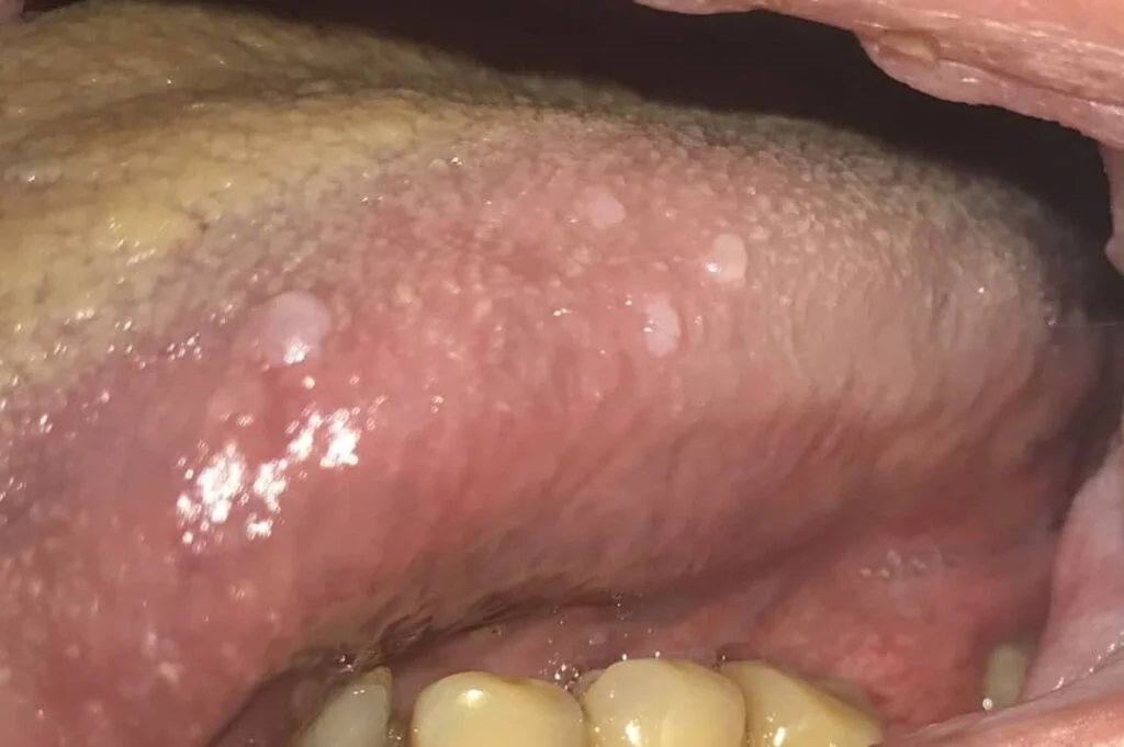 عکس زگیل تناسلی کم خطر در دهان