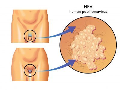 HPV کشنده است ؟