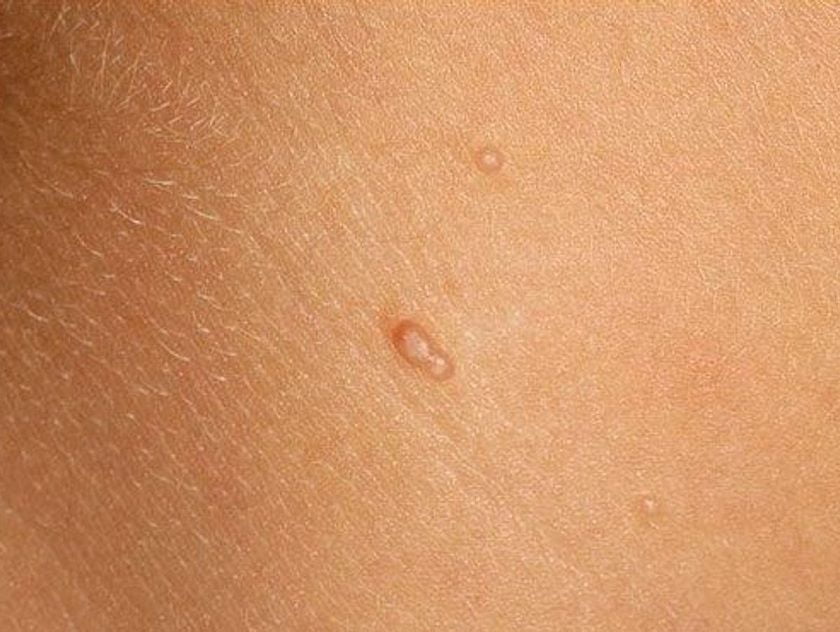 زگیل پوستی چیست و چگونه درمان می شود؟