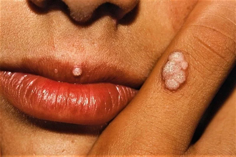 عکس زگیل اطراف زبان
